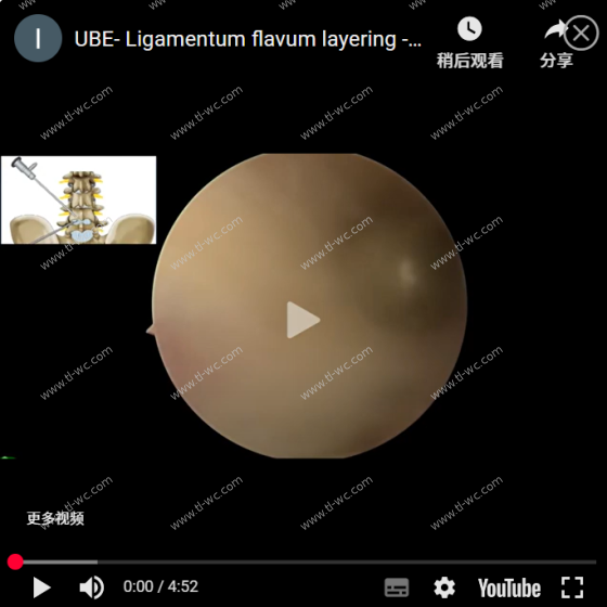 UBE-黃韌帶分層-Corner 區進入椎管進行AYDEFY手術
