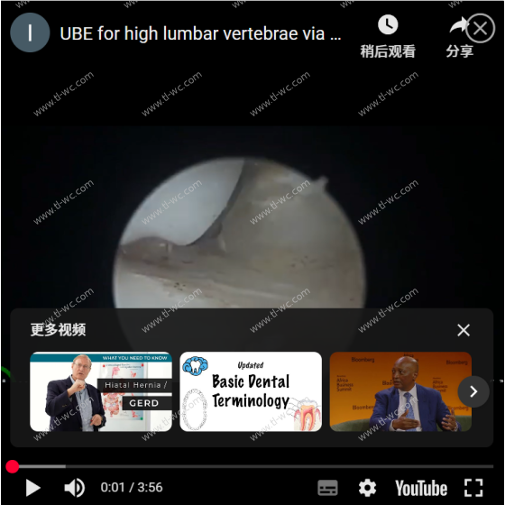 高位腰椎的UBE經椎弓根入路：一切爲了徹底