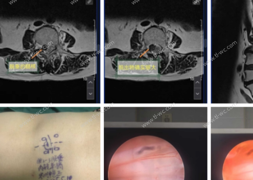 Cas de traitement d'une protubérance géante du disque lombaire avec discectomie lombaire endoscopique percutanée