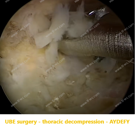 Prise en charge du processus articulaire inférieur lors de la chirurgie de révision de l'ExTLIF parascolaire